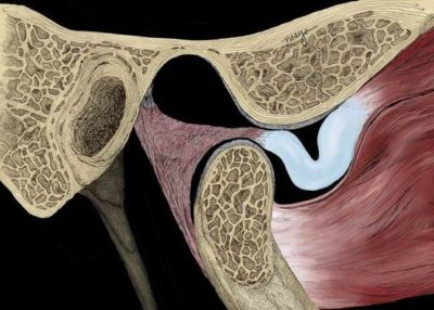 Articulación Temporomandibular - Boca abierta - Disco Luxado