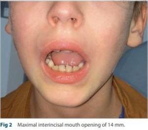 Apertura de la boca disminuida por infeccion bacteriana